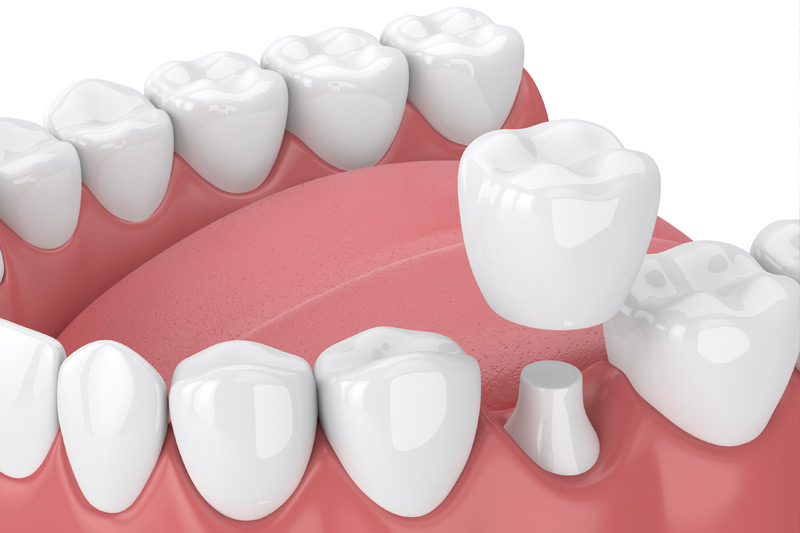 Dental Crowns in Bakersfield