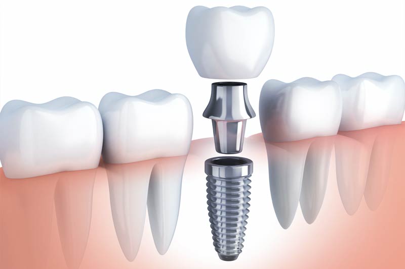 Implants Dentist in Bakersfield