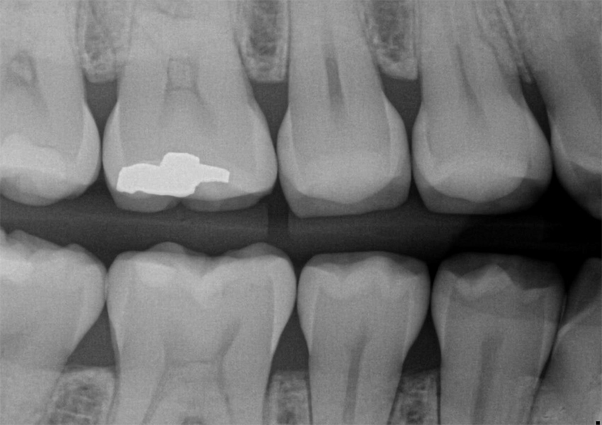 Minimally Invasive Tunnel Restorations in Bakersfield