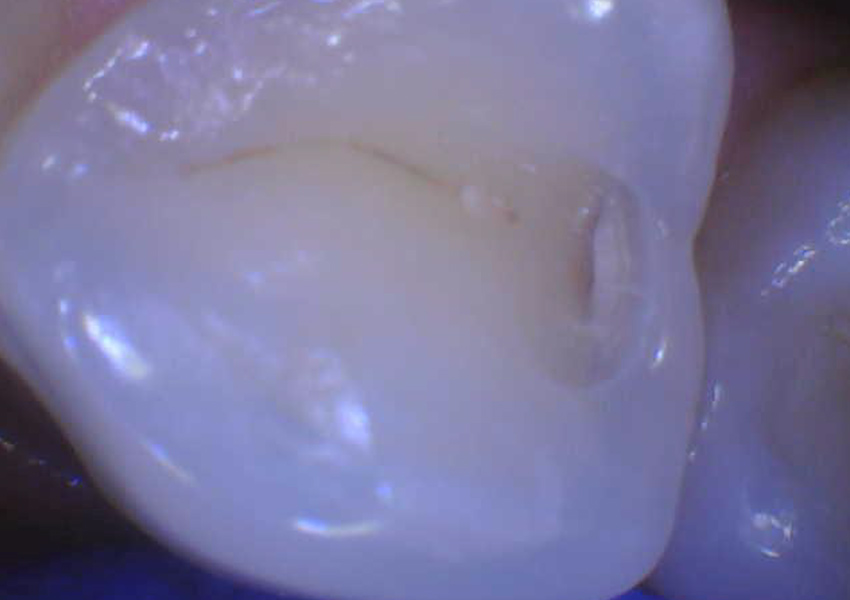 Minimally Invasive Tunnel Restorations in Bakersfield
