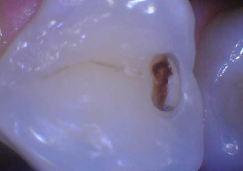 Minimally Invasive Tunnel Restorations in Bakersfield