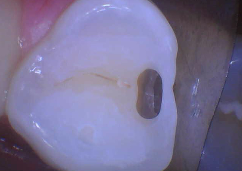 Minimally Invasive Tunnel Restorations in Bakersfield