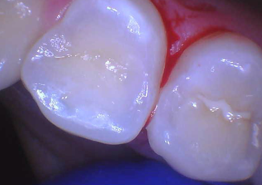 Minimally Invasive Tunnel Restorations in Bakersfield