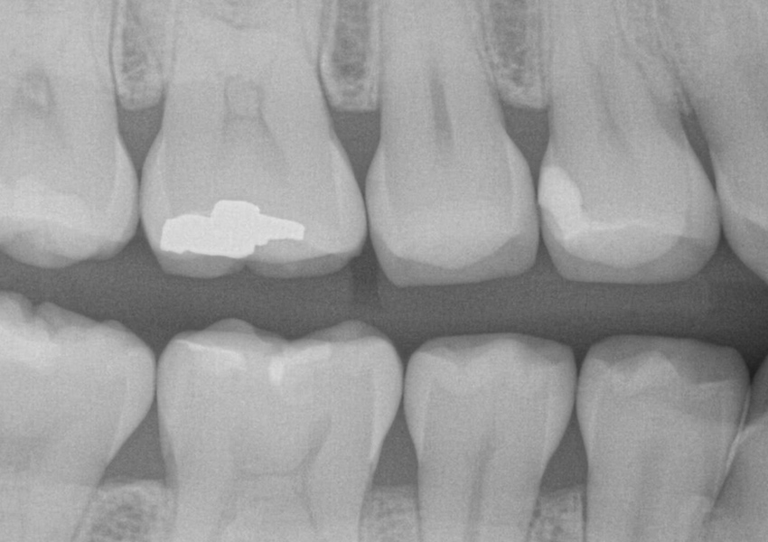 Minimally Invasive Tunnel Restorations in Bakersfield