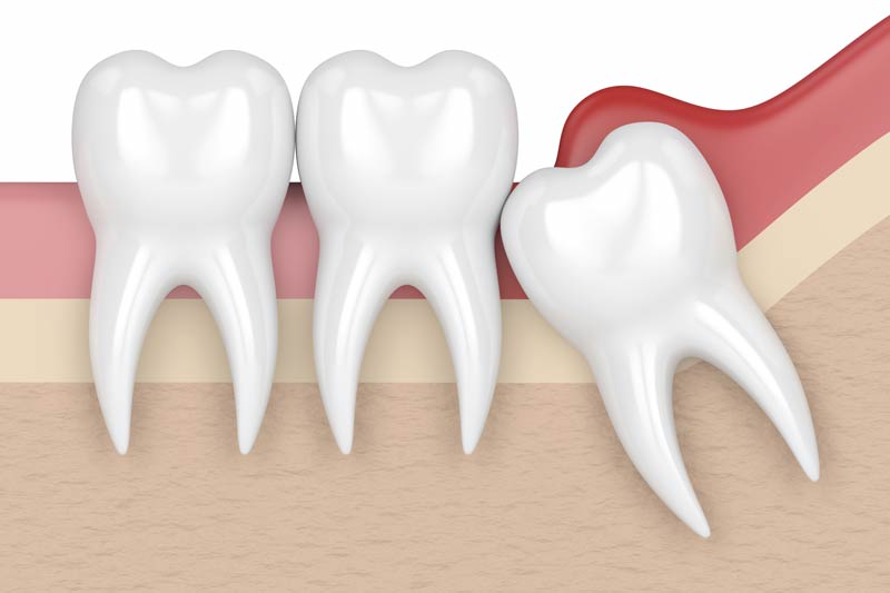 Wisdom Tooth Removal in Bakersfield
